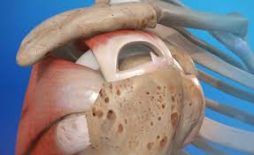 Lesão Do Manguito Rotador